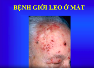 Bệnh Giời Leo