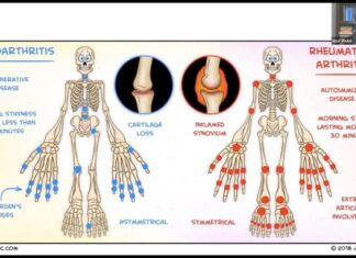 Viêm Khớp Dạng Thấp (Rheumatoid Arthritis) với bác sĩ Phạm Văn Ngà, MD – Phần 1