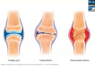 Viêm Khớp Dạng Thấp (Rheumatoid Arthritis) với bác sĩ Phạm Văn Ngà, MD – Phần 2