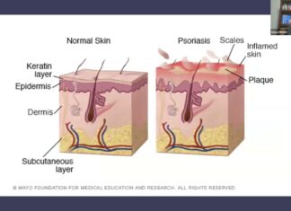 Bệnh vẩy nến Psoriasis bs Phạm Văn Ngà, MD